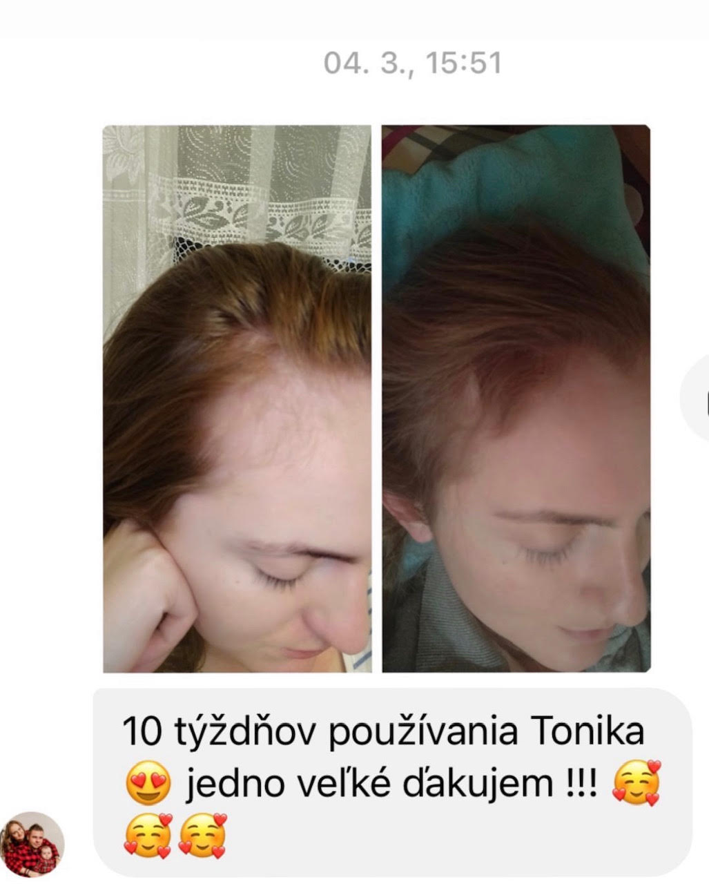 Tonikum pre rýchly rast vlasov